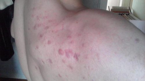 How To Get Rid Of Shoulders Acne Forums