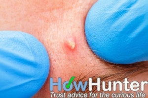 10 ways to get rid of acne overnight fast and naturally