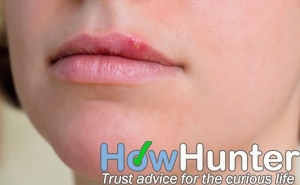 how to get rid of cold sores