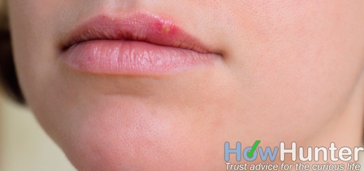 how to get rid of cold sores