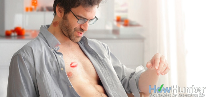 How To Get Rid Of Hickeys Fast