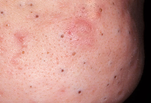 get rid of deep blackheads