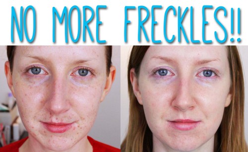 get rid of freckles on the face