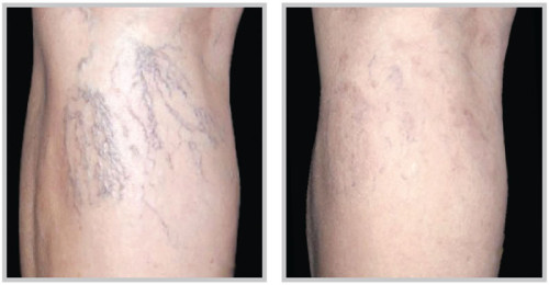 get rid of spider veins on legs