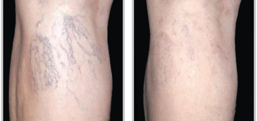 get rid of spider veins on legs