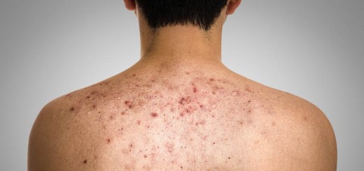 get rid of back acne