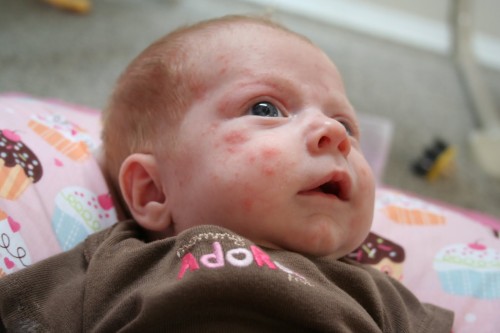 baby acne remedy