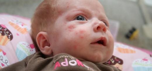 baby acne remedy