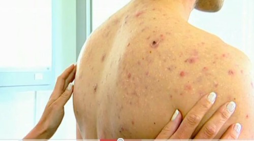 get rid of back acne