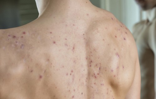 get rid of back acne