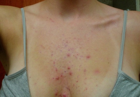 get rid of chest acne fast