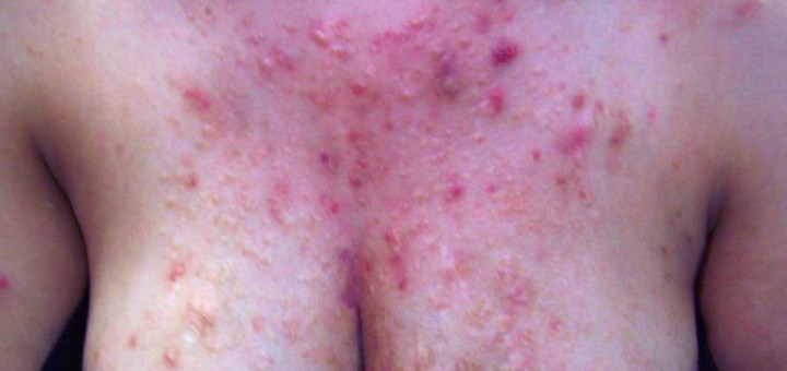 get rid of chest acne