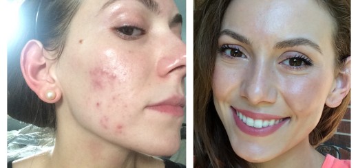 get rid of hormonal acne