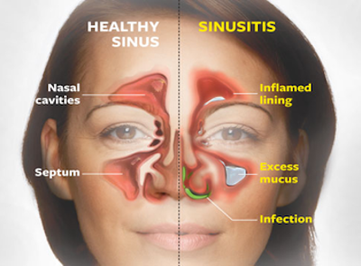 sinus headache