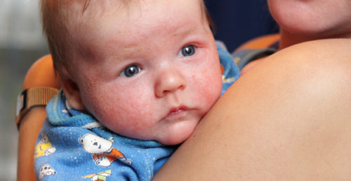 get rid of baby eczema