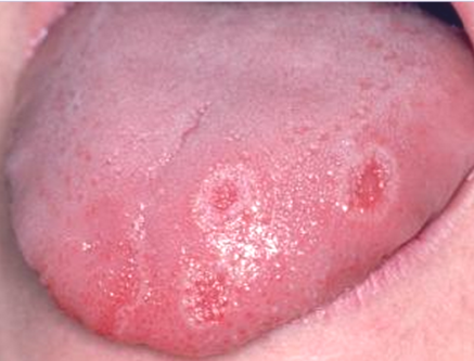 canker sores on tongue