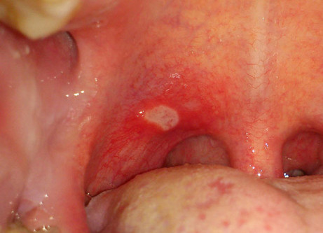 cold sores in mouth pictures