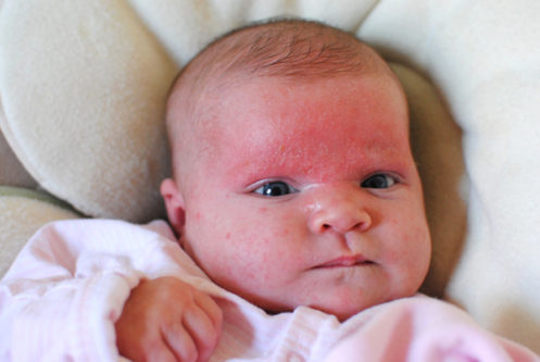 cradle cap pictures