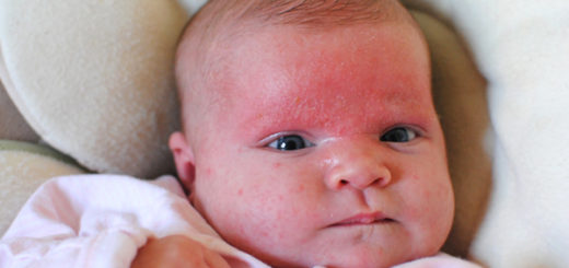 cradle cap pictures