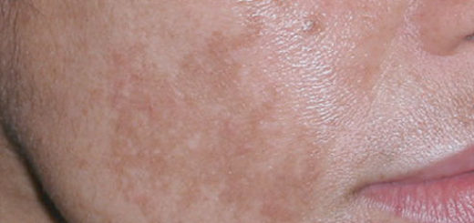 dark spots on face