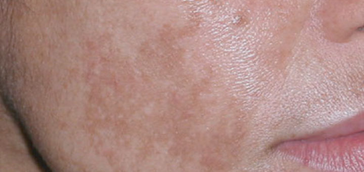 dark spots on face