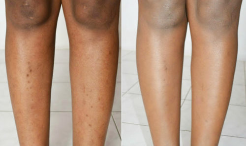 dark spots on legs