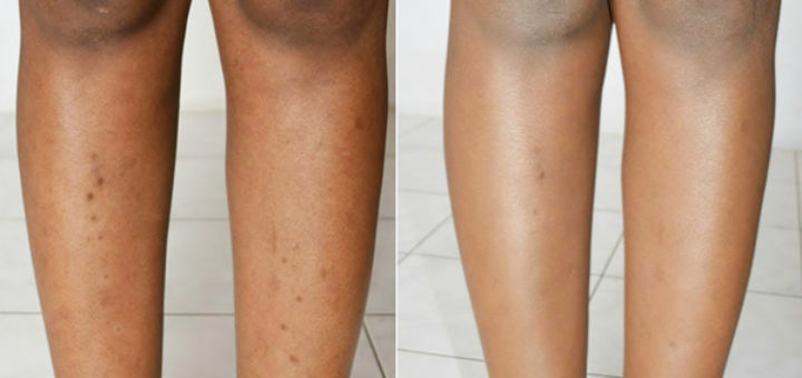 dark spots on legs