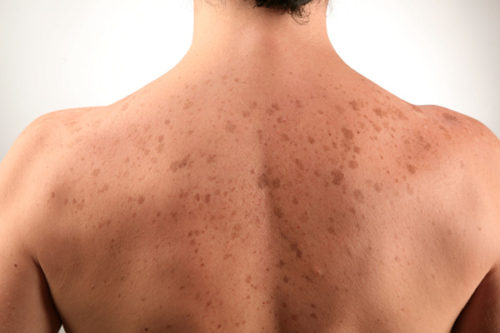 dark spots on skin pics