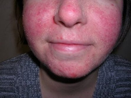 eczema on face