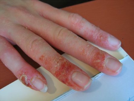 eczema on hands