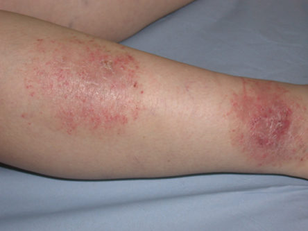 get rid of eczema on legs