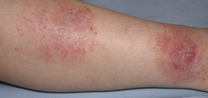 get rid of eczema on legs