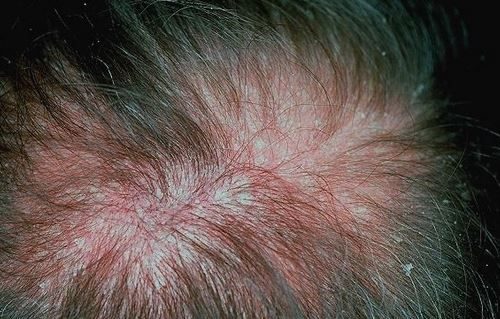 eczema on scalp