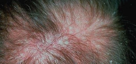 eczema on scalp