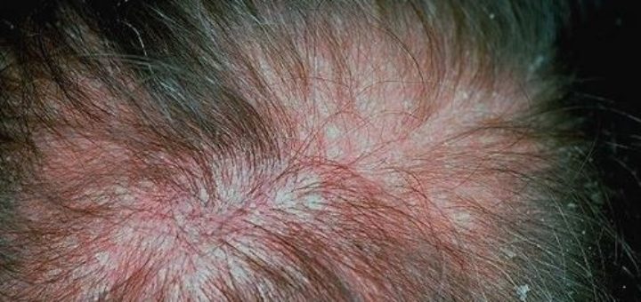 eczema on scalp