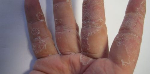 extremely dry skin on hands