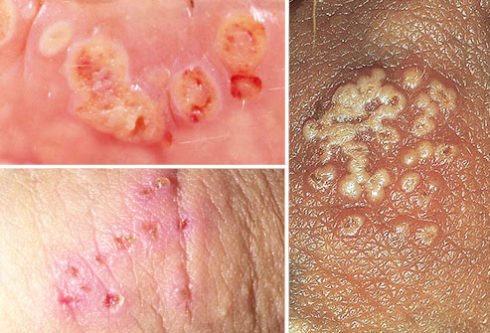 genital herpes pictures