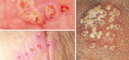 genital herpes pictures