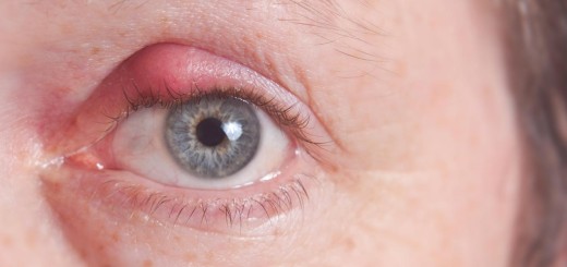 stye on your eye