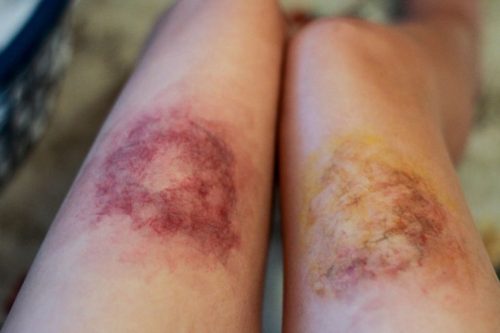 bruises on legs pictures