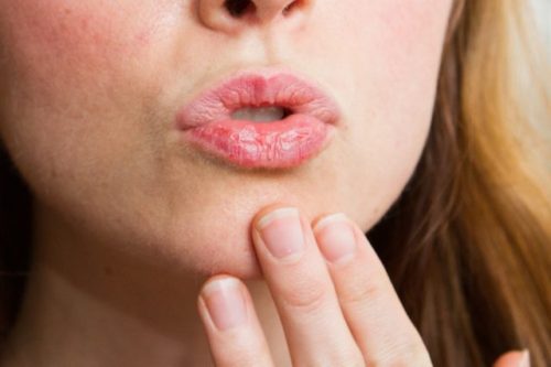 get rid of chapped lips