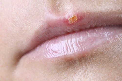 fever blisters on lip