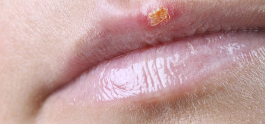 fever blisters on lip