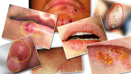 get rid of herpes fast