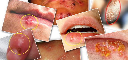 get rid of herpes fast