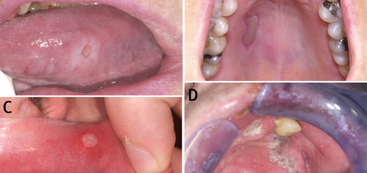 get rid of herpes in mouth