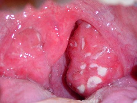 oral herpes pictures