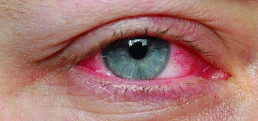 pink eye pictures