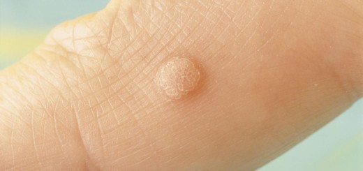 plantar warts pictures