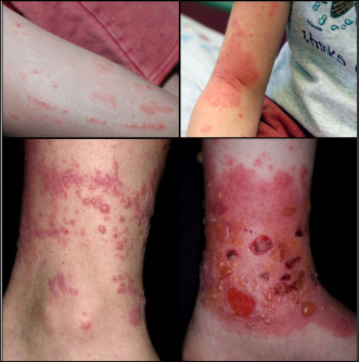 get rid of poison Ivy rash